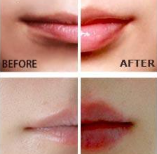 Miracle Lip Plumper — Fuller, Kissable Lips Instantly